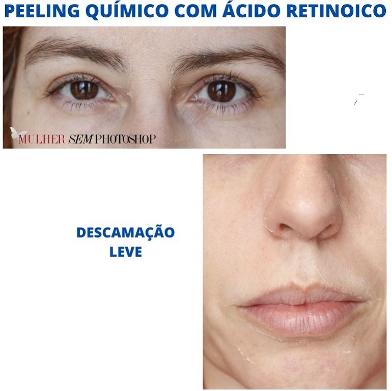 peeling quimico com ácido retinoico resenha