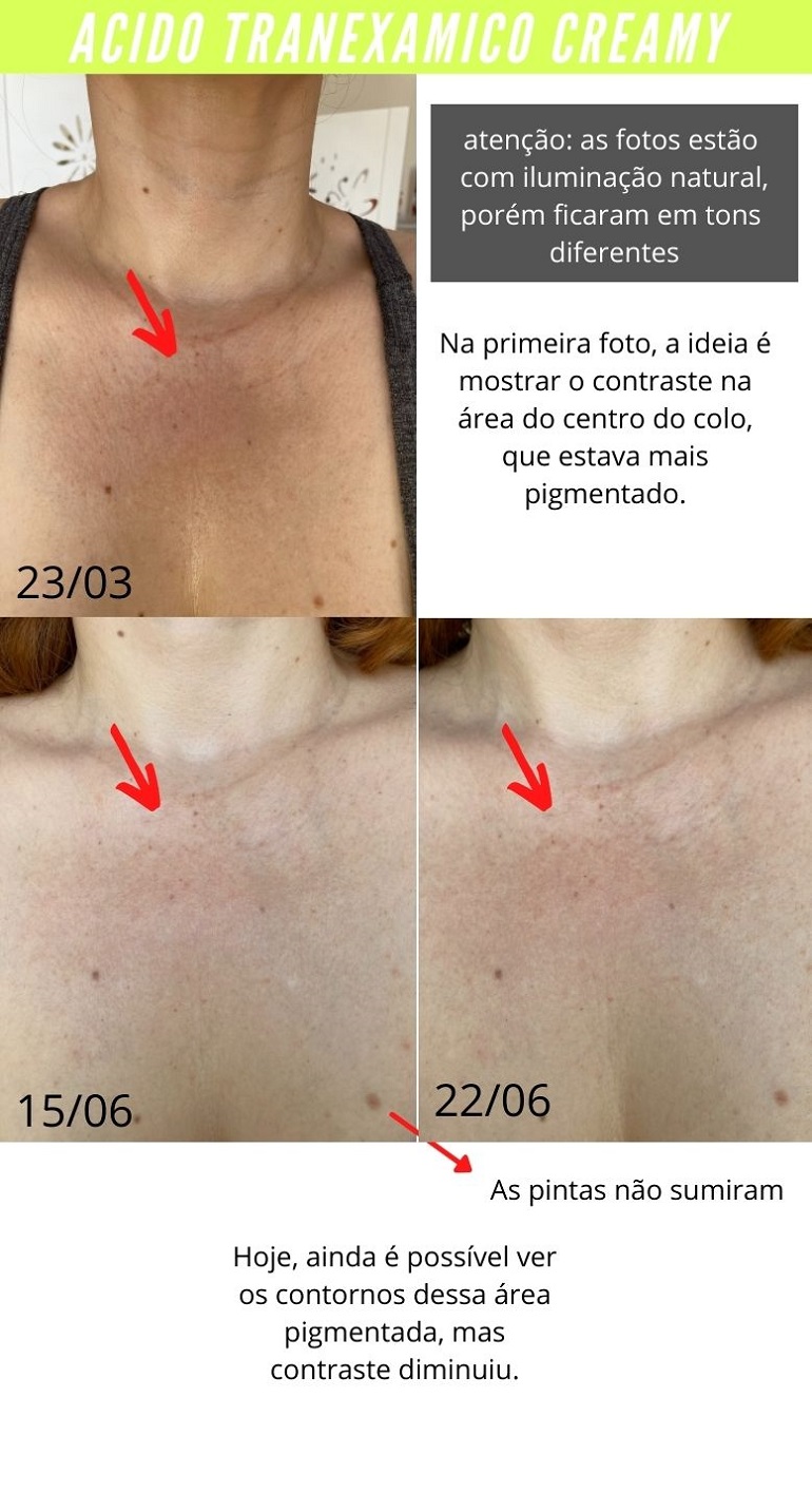 Creamy Tranexamico antes e depois